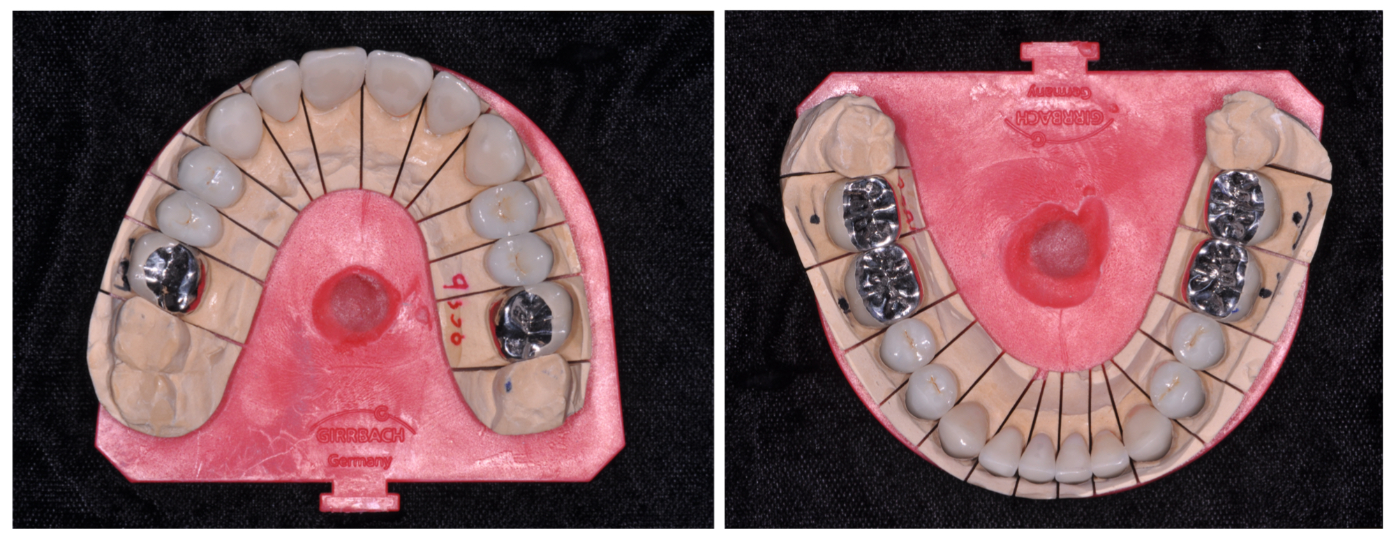 Full Mouth Rehabilitation DentalSpecialistsScotts